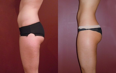 Woman treated with Cryoskin - Woman treated with Cryoskin