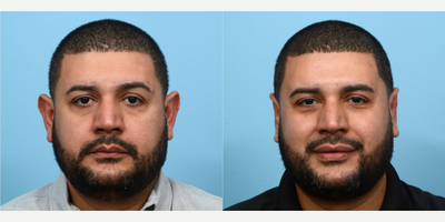 35-44 year old man treated with Earfold - This 36-year-old patient had an otoplasty, commonly referred to as ear pinning surgery, in order to reduce the size and projection of his ears. 10 weeks post-op the patient is happy to see such a huge improvement in his overall appearance and feels much more confident wearing his hair short.
