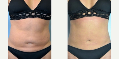 Liposuction Revision - This patients asymmetries and shelves of fat were visible through shirts. Revision liposuction smoothed the uneven areas and gave her a more feminine shape.