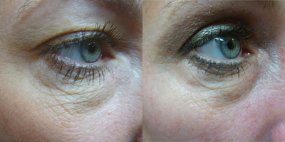 25-34 year old woman treated with Skintyte - SkinTyte 3 months after 2 treatments