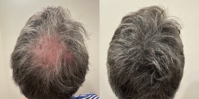 55-64 year old man treated with Scalp Micropigmentation - before and after SMP treatment for a Male patient desiring more fullness to the crown.