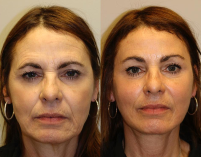 Woman treated with Skin Rejuvenation - Woman treated with Skin Rejuvenation through laser resurfacing as well as facelift and brow lift. Patient was tired of people asking her as if she was mad or angry.