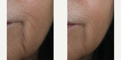 Skinbetter Science - InterFuse Intensive Treatment Lines.Photo provided courtesy of Skinbetter Science.