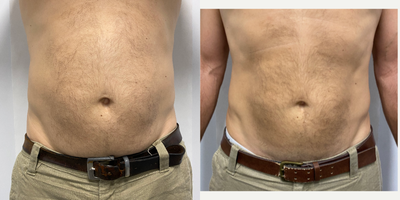 45-54 year old man treated with Forma - 50 year old male treated with 1x cool sculpting treatment and 6x TeslaFormer treatments.