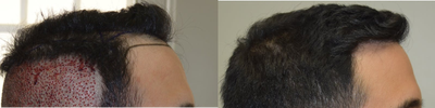 25-34 year old man treated with FUE Hair Transplant, PRP for Hair Loss, Exo-Xom - Our clients 6 month follow up, at only 50% density! Another 50% density to come over the next 6 months! Looks phenomenal, and our client is extremely happy with his results. Client had a total of 3700 grafts done, with approximately 2500 for reconstruction of the hairline, and the subsequent areas, and about 1200 grafts to add density to the crown/vertex, which was thinning and see through.
