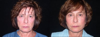 Lower Facelift - 	This patient was unhappy not only with the position and shape of her brows, but the excess loose skin of her face and neck. I performed an endoscopic browlift through small incisions hidden behind her hairline, as well as a lower face and neck lift, an upper blepharoplasty, and fat transfer to her cheeks. This combination of procedures has given her an improved jawline, neckline, brow position and cheek fullness, as well as an overall refreshed, youthful look.