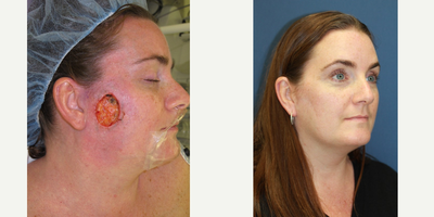 Mohs Surgery Reconstruction - Mohs Surgery Reconstruction