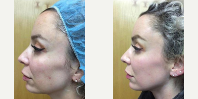 Woman treated with Fraxel Laser - Woman treated with Fraxel Laser