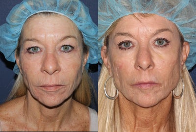56 year old female with wrinkles around mouth and eyes  - 
	56 year old female concerned about wrinkles around her mouth, eyes, and cheeks. I treated her one time with a combination of Fraxel Repair, CO2, Erbium, and Alex lasers. Notice the incredible wrinkle reduction in these areas. This is one treatment.
