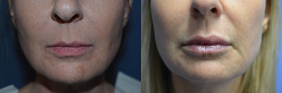 46 y/o female interested in increasing the fullness of her lips - 46 y/o female who was interested in increasing her lips' fullness.  She was injected with one syringe of Juvederm Ultra Plus XC.