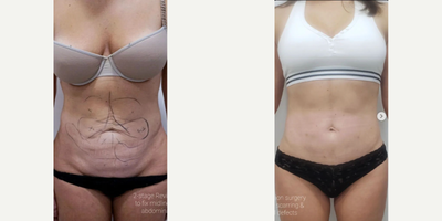 Woman treated with Liposuction Revision - Woman treated with Liposuction Revision