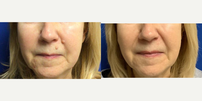 65-74 year old woman treated with Mole Removal - 6 months post mole removal