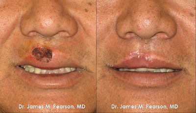 Lip Reconstruction - 
	Lip Reconstruction
