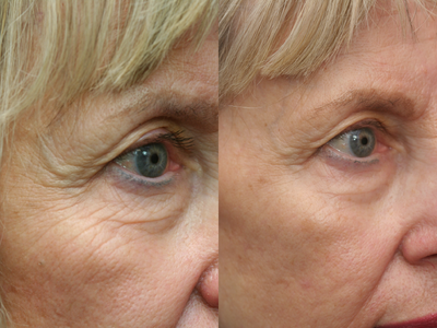 Pelleve - 68 year old young lade before and after 4 Pelleve treatments. This is a gentle series of treatments in the office that requires no down time. There is little or not pain.