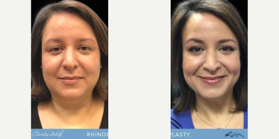 Woman treated with Rhinoplasty - Curious about this breathtaking change? Behold the wonders of Rhinoplasty! See the art of nose reshaping in action, creating balance, and amplifying natural charm. Rhinoplasty isn't just surgery; it's a path to newfound confidence and personal expression