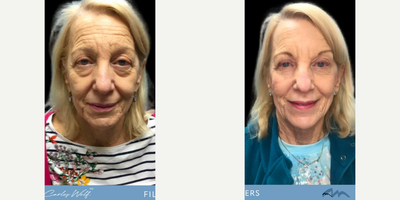 Woman treated with Dermal Fillers - Eyes that have seen 74 years of wisdom, now sparkling with a touch of elegance. Dr. Wolfs expertise in fillers has woven a story of age-defying beauty without surgery. Its proof that confidence knows no bounds. Heres to celebrating the journey, the laughter lines, and the moments that make us truly timeless.