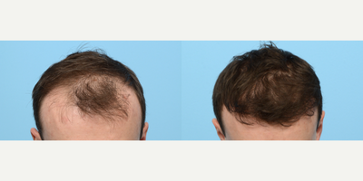 25-34 year old man treated with FUE Hair Transplant, Hair Transplant, Hair Loss Treatment, PRP for Hair Loss, NeoGraft, Low-Leve - This 28-year-old patient was experiencing thinning hair in his crown area and a receding hairline. Due to his family history of hair loss, he wanted to take action as it was progressively worsening. To rebuild hairline and add density to the crown, Dr. Wise performed an FUE hair transplant using 2,515 grafts. During the procedure, the patient also underwent PRP therapy to strengthen the follicles and expedite healing.
