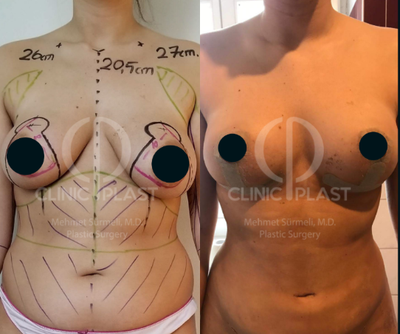 25-34 year old woman treated with Breast Lift - 26 year-old female treated with superomedial pedicled breast lift, whole body 3-D VASER liposculpting and safe gluteal fat transfer.