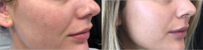 Woman treated with Vivace - Woman treated with Vivace