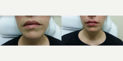 Woman treated with Belotero - Woman treated with Belotero.