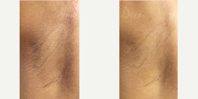 35-44 year old woman treated with Laser Peel, Laser Resurfacing - Treatment of darkening and pigmentation of under arms with Erbium laser skin resurfacing