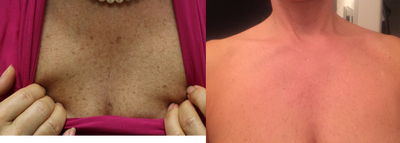 1 Month Post Cutera Laser Treatment - This patient used our Cutera Excel V laser and received this outcome within a month after just one treatment. (Results may vary. Some patients need multiple treatments.)
