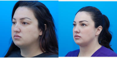 35-44 year old woman treated with Microdermabrasion - Patient is 3 months from open rhinoplasty, buccal fat removal, and deep neck lift without ear incisions. She has also had lip filler and microneedling