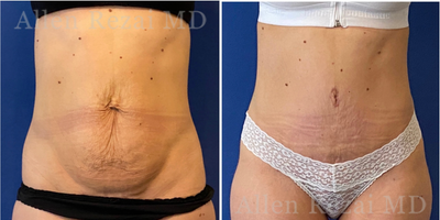35-44 year old woman treated with Mommy Makeover, Tummy Tuck - 	Photos: Pre- & 6 Weeks Post-op	Note: It normally takes 9-12 months for scars to heal and fade into fine lines.