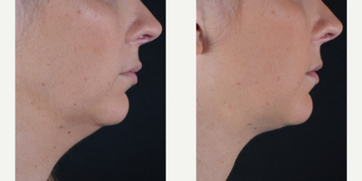 CoolMini - Results show marked improvement in the neck and jawline after just 1 session of CoolMini!