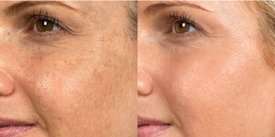 45-54 year old woman treated with Halo Laser - 45-54 year old woman treated with Halo Laser targeting pigmentation and fine lines