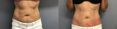 45-54 year old woman treated with Cryoskin  - (8) 30 Minute Manual Toning Sessions Every 5 Days