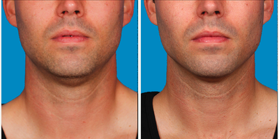 25-34 year old man treated with Kybella for corruption of sub mental fullness /double chin - 25-34 year old man treated with Kybella for corruption of sub mental fullness /double chin