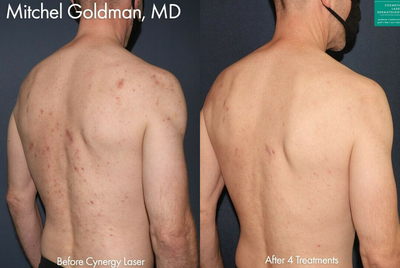 Man treated with Pulsed Dye Laser - Cynergy laser to treat port wine stain on neck by Dr. Goldman.