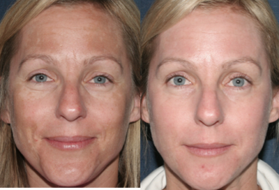 Fraxel Laser for Hyperpigmentation - 
	Fraxel Laser with Dr. Groff for pigmentation problems.
