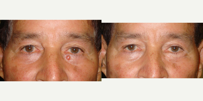 68 year old man treated with eyelid Mohs Surgery - 68 year old male, who underwent left lower eyelid basal cell carcinoma removal through Mohs techniques followed by eyelid reconstruction.