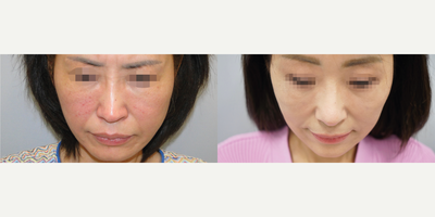 Deep Plane Facelift, Revision Rhinoplasty, Square Jaw Reduction - Deep Plane Facelift, Revision Rhinoplasty (Rib cartilage), Square Jaw Reduction performed by Dr. Myung Ju Lee of VIP Plastic Surgery Korea