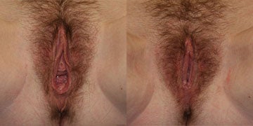 Vaginoplasty Before and After Photos