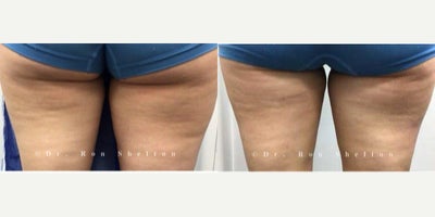 35-44 year old woman treated with Aveli - This impressive result came from just one Avli treatment targeting the marked dimples. The results are typically long-lasting, and no additional treatments are expected.