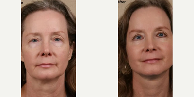 Woman treated with Facelift - Woman treated with Facelift