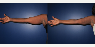 45-54 year old woman treated with Renuvion - Liposuction to arms and Renuvion