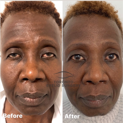 45-54 year old woman treated with Ptosis Surgery - Ptosis is a common condition that can occur at any age and is often caused by a slippage of the muscles that raises the eyelids making the eyes appear smaller. The added difficulty in her case was that she was prone to keloid scarring because of her skin type. To address this issue I performed an internal lid ptosis repair and avoided an external skin incision altogether. The after picture was taken 1 week after surgery. 