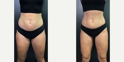Woman treated with CoolSculpting Elite - These results are after ONLY 2 sessions of CoolSculpting Elite!
