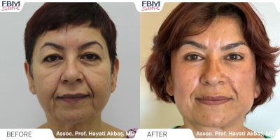 55-64 year old woman treated with Double Eyelid Surgery, Deep Plane Facelift - 55-64 year old woman treated with Double Eyelid Surgery, Deep Plane Facelift