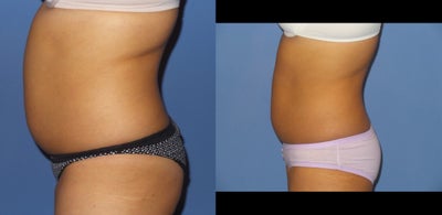 32 y/o female with one treatment of SculpSure to her abdomen and flanks. - 32 y/o female shown 12 weeks after second treatment with Sculpsure to her abdomen and flanks.