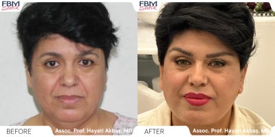45-54 year old woman treated with Deep Plane Facelift, Eyelid Surgery, Neck Lift - 55-64 year old woman treated with Deep Plane Facelift, Forehead Reduction, Eyelid Surgery, Lip Lift