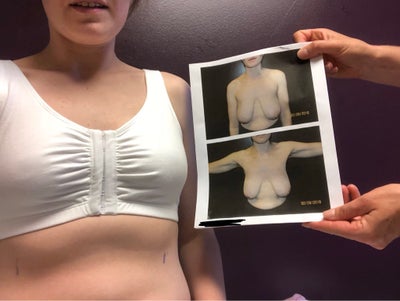 Before and After: 34AA to 28DD/30D : r/ABraThatFits