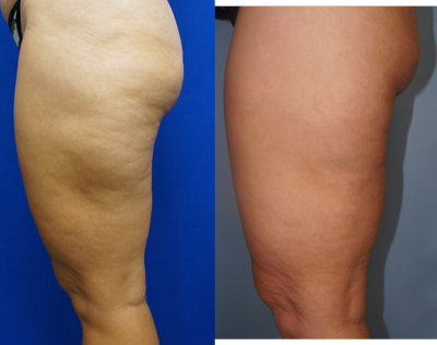 43 year old treated with Cellulaze of thighs - 
	42 yer old treated with 48 squares of cellulaze 6 months ago
