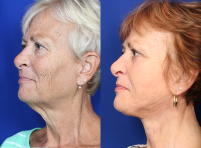 55-64 year old woman treated with Facelift - 62 year old female wanting to freshen her look.