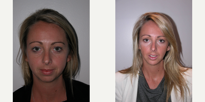 25-34 year old woman treated with Chin Surgery - Genioplasty