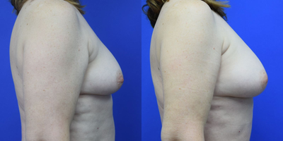 45-54 year old woman treated with Breast Fat Transfer - Fat transfer of about 400cc per breast. 3 month post fat grafting result.